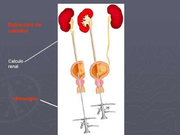 Extraccion de calculos Calculo renal citoscopio 