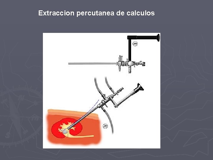 Extraccion percutanea de calculos 