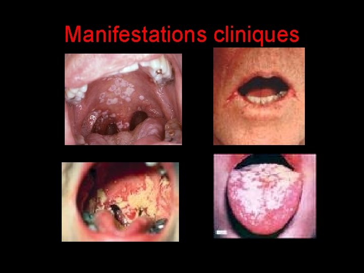 Manifestations cliniques 