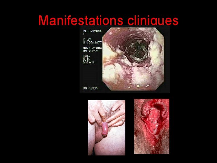 Manifestations cliniques 