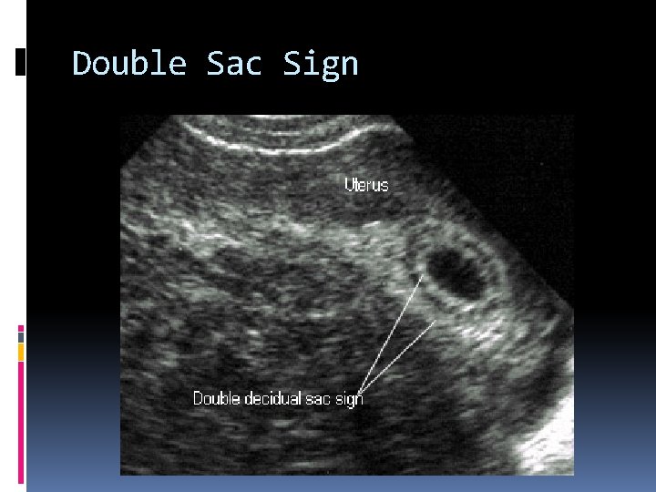 Double Sac Sign 