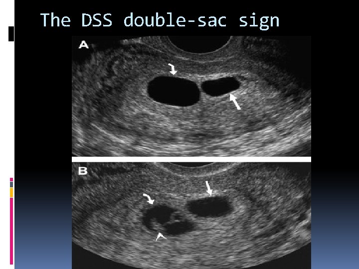 The DSS double-sac sign 