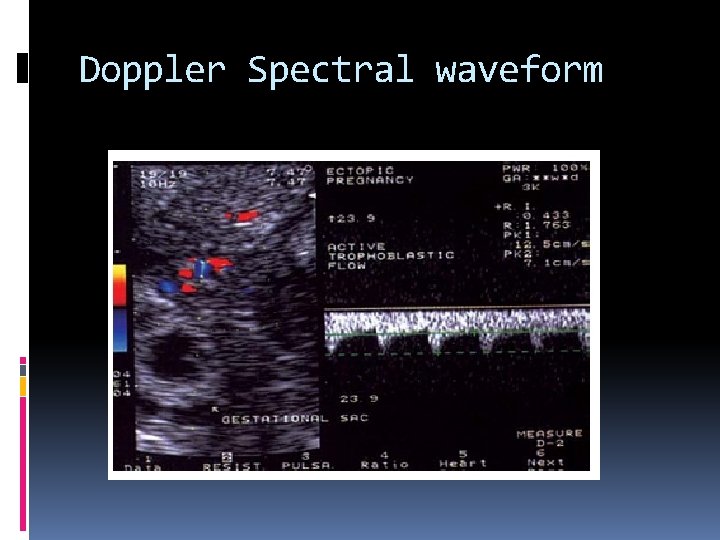 Doppler Spectral waveform 