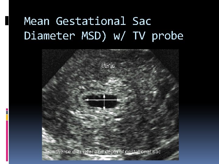 Mean Gestational Sac Diameter MSD) w/ TV probe 