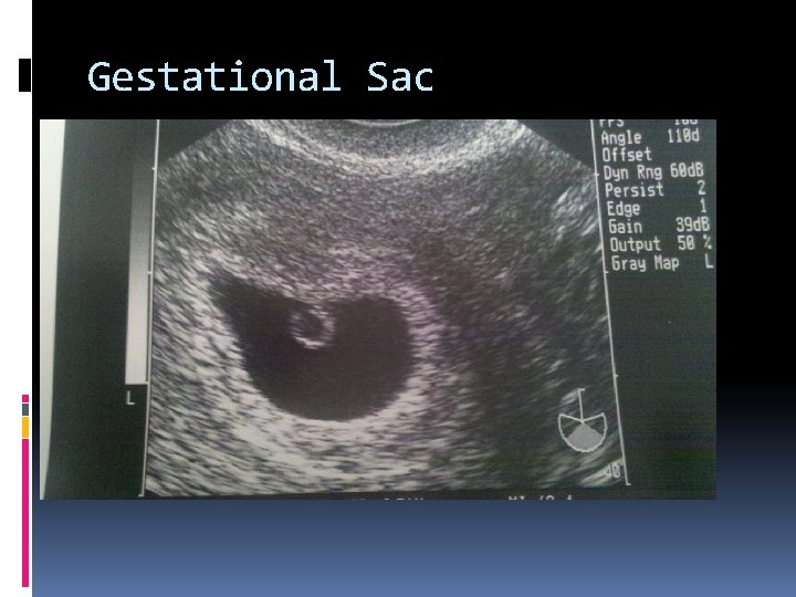 Gestational Sac 