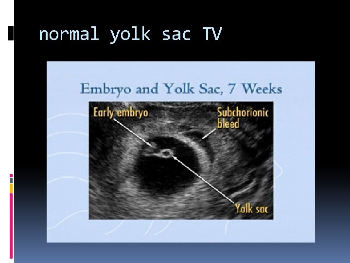 normal yolk sac TV 