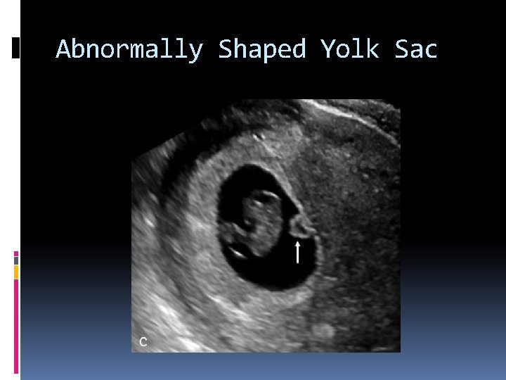Abnormally Shaped Yolk Sac 
