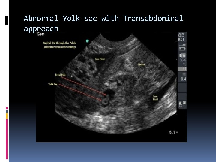Abnormal Yolk sac with Transabdominal approach 