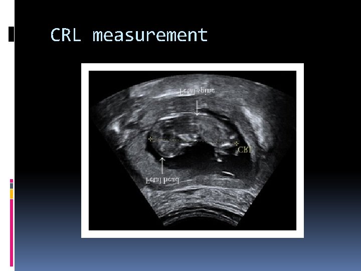  CRL measurement 