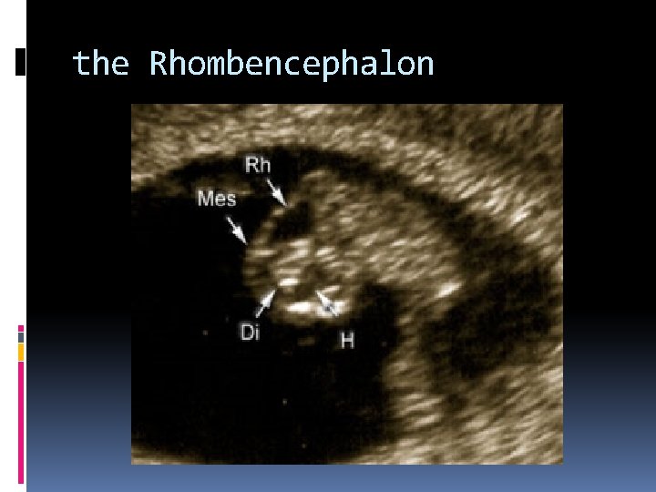 the Rhombencephalon 