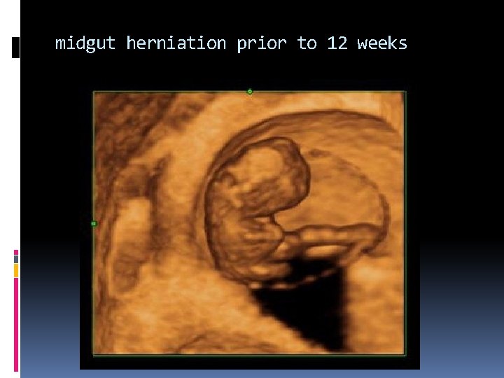 midgut herniation prior to 12 weeks 
