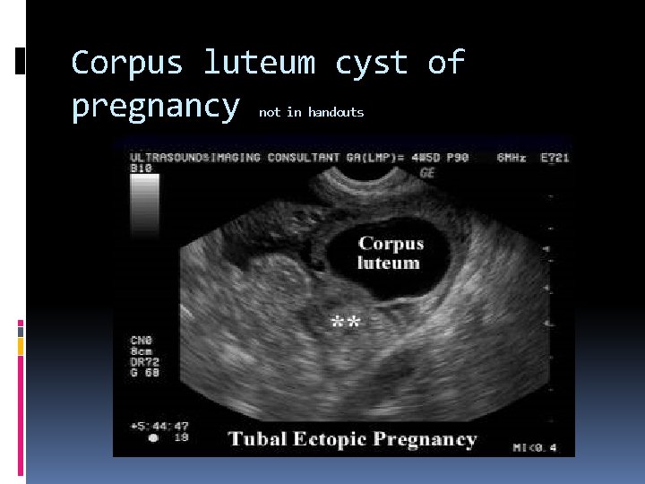 Corpus luteum cyst of pregnancy not in handouts 