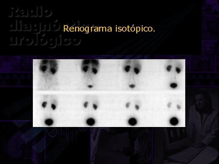 Renograma isotópico. 