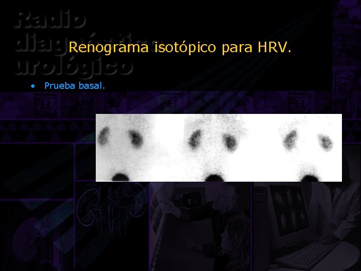 Renograma isotópico para HRV. • Prueba basal. 