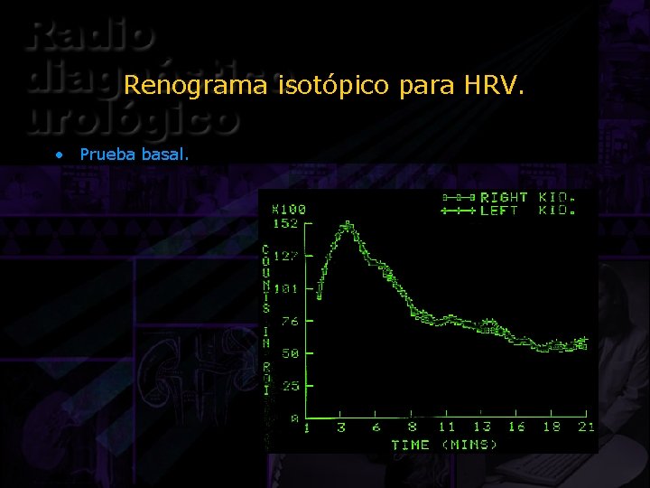 Renograma isotópico para HRV. • Prueba basal. 