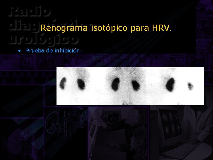 Renograma isotópico para HRV. • Prueba de inhibición. 