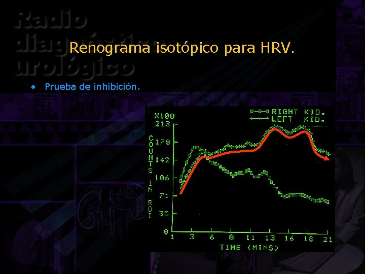 Renograma isotópico para HRV. • Prueba de inhibición. 