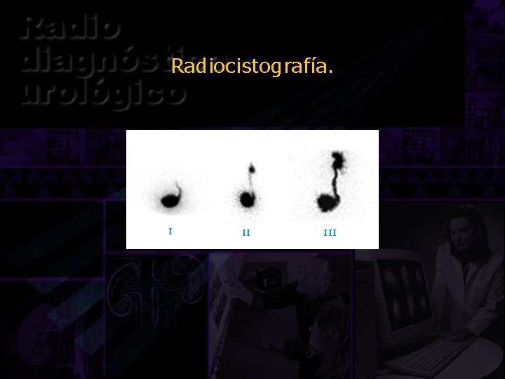 Radiocistografía. I II III 