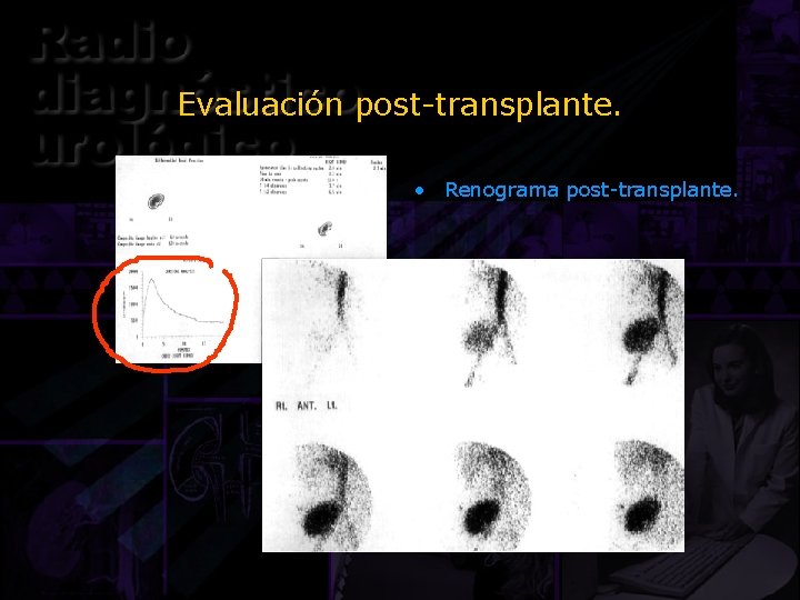 Evaluación post-transplante. • Renograma post-transplante. 