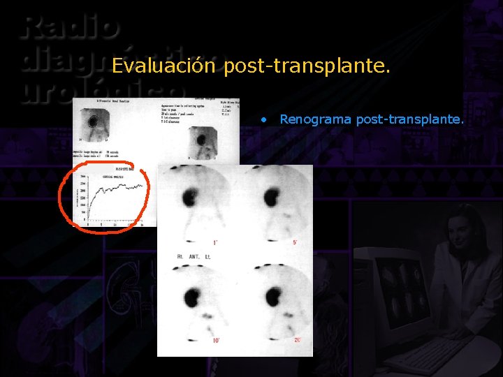 Evaluación post-transplante. • Renograma post-transplante. 