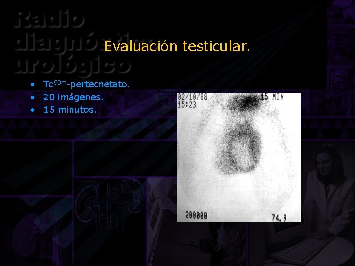 Evaluación testicular. • Tc 99 m-pertecnetato. • 20 imágenes. • 15 minutos. 