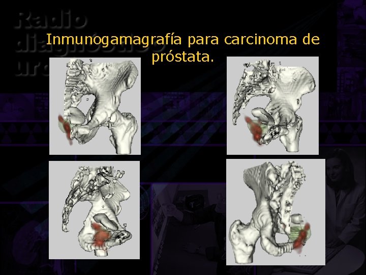 Inmunogamagrafía para carcinoma de próstata. 