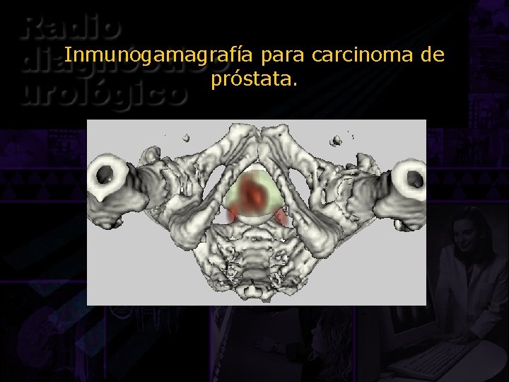 Inmunogamagrafía para carcinoma de próstata. 