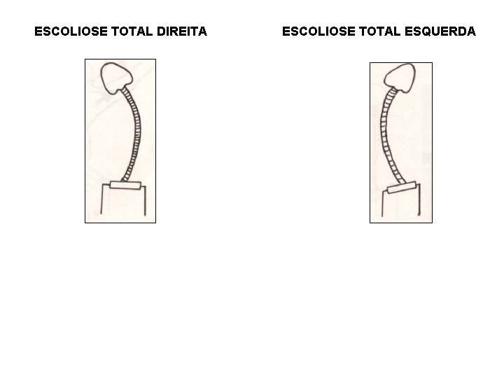 ESCOLIOSE TOTAL DIREITA ESCOLIOSE TOTAL ESQUERDA 