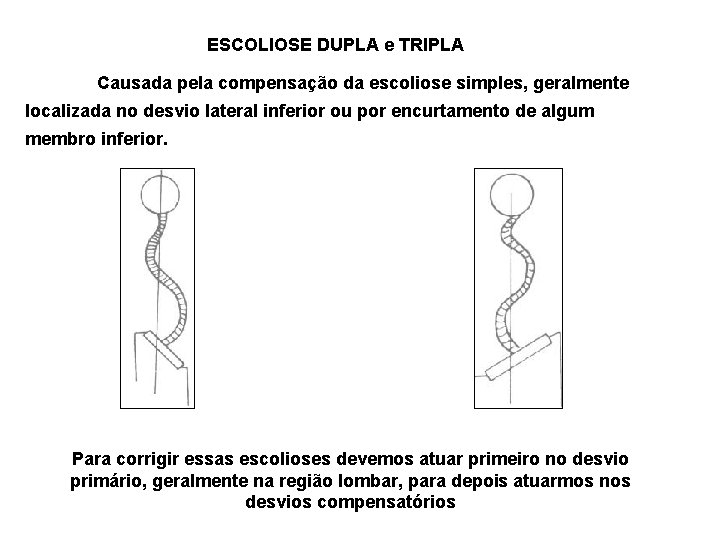 ESCOLIOSE DUPLA e TRIPLA Causada pela compensação da escoliose simples, geralmente localizada no desvio