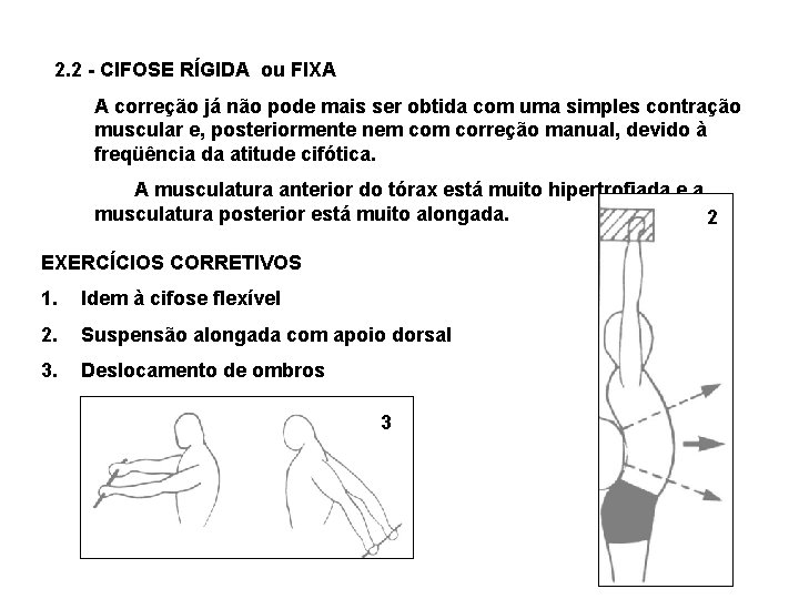 2. 2 - CIFOSE RÍGIDA ou FIXA A correção já não pode mais ser