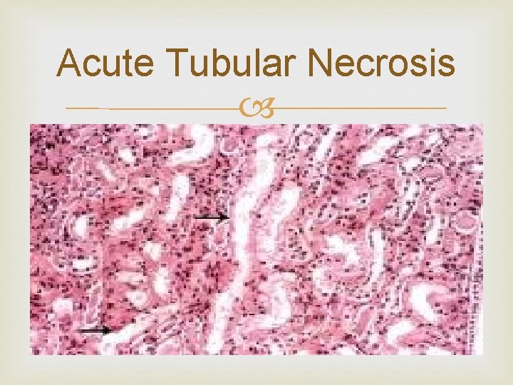 Acute Tubular Necrosis Acute Tubular Necrosis