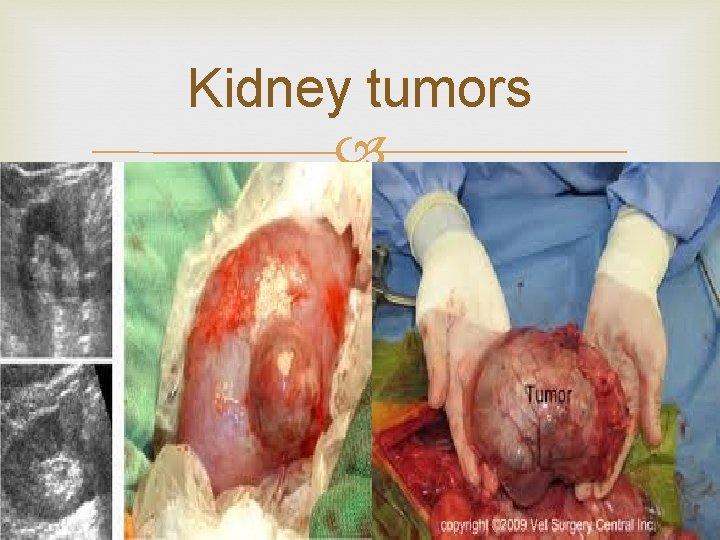 Kidney tumors 