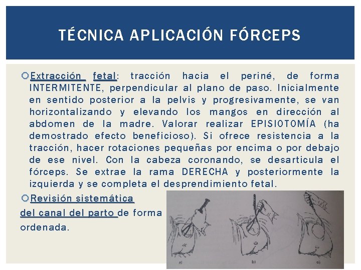 TÉCNICA APLICACIÓN FÓRCEPS Extracción fetal: fetal tracción hacia el periné, de forma INTERMITENTE, perpendicular