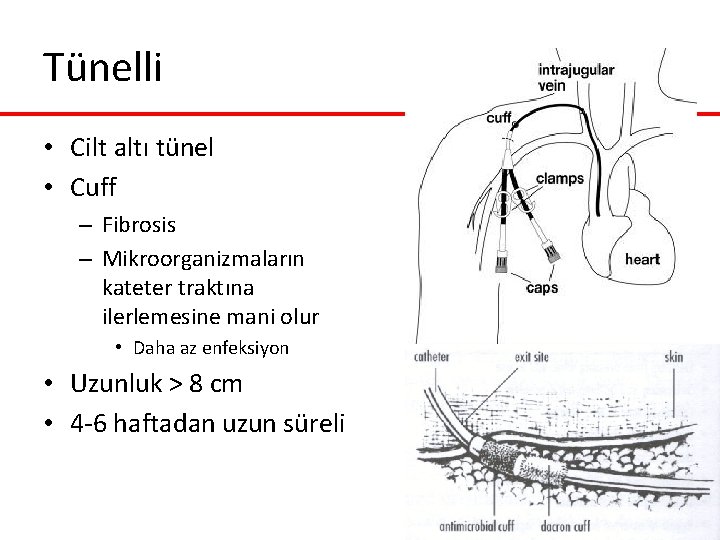 Tünelli • Cilt altı tünel • Cuff – Fibrosis – Mikroorganizmaların kateter traktına ilerlemesine Tünelli • Cilt altı tünel • Cuff – Fibrosis – Mikroorganizmaların kateter traktına ilerlemesine