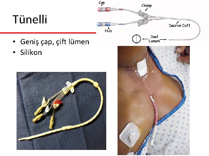Tünelli • Geniş çap, çift lümen • Silikon Tünelli • Geniş çap, çift lümen • Silikon