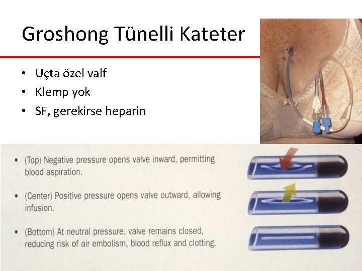 Groshong Tünelli Kateter • Uçta özel valf • Klemp yok • SF, gerekirse heparin Groshong Tünelli Kateter • Uçta özel valf • Klemp yok • SF, gerekirse heparin
