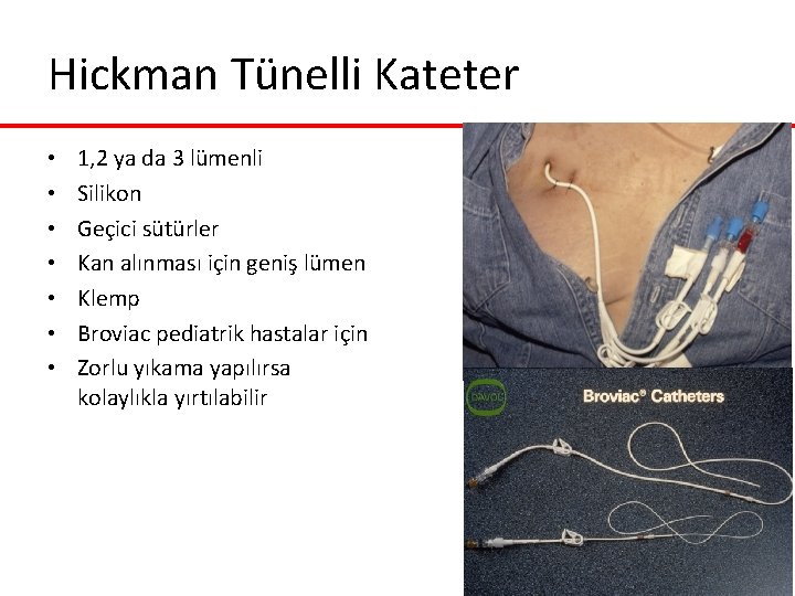Hickman Tünelli Kateter • • 1, 2 ya da 3 lümenli Silikon Geçici sütürler Hickman Tünelli Kateter • • 1, 2 ya da 3 lümenli Silikon Geçici sütürler