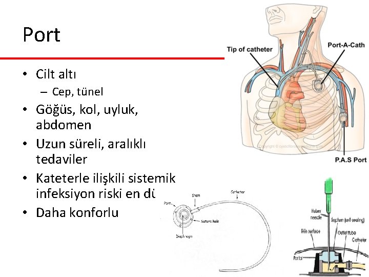 Port • Cilt altı – Cep, tünel • Göğüs, kol, uyluk, abdomen • Uzun Port • Cilt altı – Cep, tünel • Göğüs, kol, uyluk, abdomen • Uzun