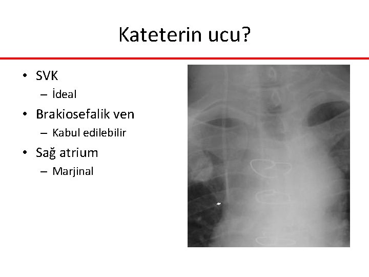 Kateterin ucu? • SVK – İdeal • Brakiosefalik ven – Kabul edilebilir • Sağ Kateterin ucu? • SVK – İdeal • Brakiosefalik ven – Kabul edilebilir • Sağ