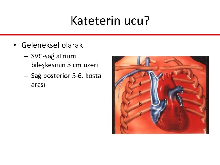 Kateterin ucu? • Geleneksel olarak – SVC-sağ atrium bileşkesinin 3 cm üzeri – Sağ Kateterin ucu? • Geleneksel olarak – SVC-sağ atrium bileşkesinin 3 cm üzeri – Sağ