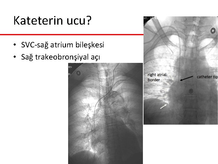 Kateterin ucu? • SVC-sağ atrium bileşkesi • Sağ trakeobronşiyal açı Kateterin ucu? • SVC-sağ atrium bileşkesi • Sağ trakeobronşiyal açı