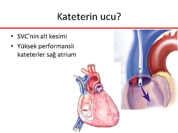 Kateterin ucu? • SVC’nin alt kesimi • Yüksek performanslı kateterler sağ atrium Kateterin ucu? • SVC’nin alt kesimi • Yüksek performanslı kateterler sağ atrium