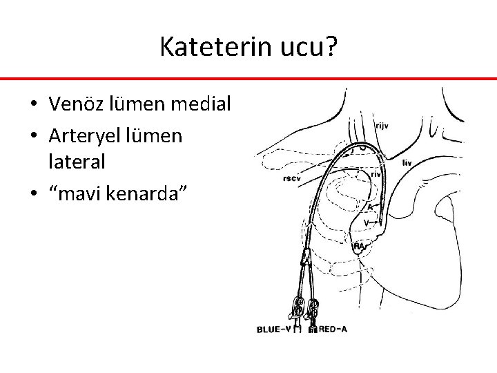 Kateterin ucu? • Venöz lümen medial • Arteryel lümen lateral • “mavi kenarda” Kateterin ucu? • Venöz lümen medial • Arteryel lümen lateral • “mavi kenarda”