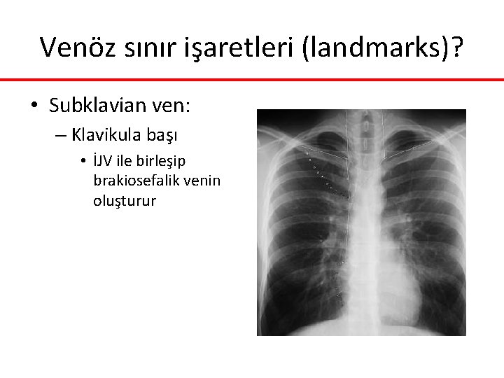 Venöz sınır işaretleri (landmarks)? • Subklavian ven: – Klavikula başı • İJV ile birleşip Venöz sınır işaretleri (landmarks)? • Subklavian ven: – Klavikula başı • İJV ile birleşip