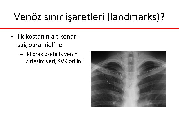 Venöz sınır işaretleri (landmarks)? • İlk kostanın alt kenarısağ paramidline – İki brakiosefalik venin Venöz sınır işaretleri (landmarks)? • İlk kostanın alt kenarısağ paramidline – İki brakiosefalik venin