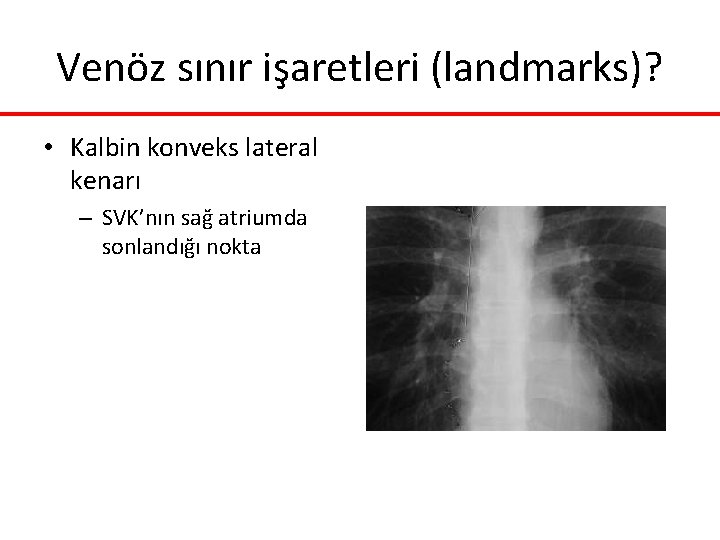 Venöz sınır işaretleri (landmarks)? • Kalbin konveks lateral kenarı – SVK’nın sağ atriumda sonlandığı Venöz sınır işaretleri (landmarks)? • Kalbin konveks lateral kenarı – SVK’nın sağ atriumda sonlandığı