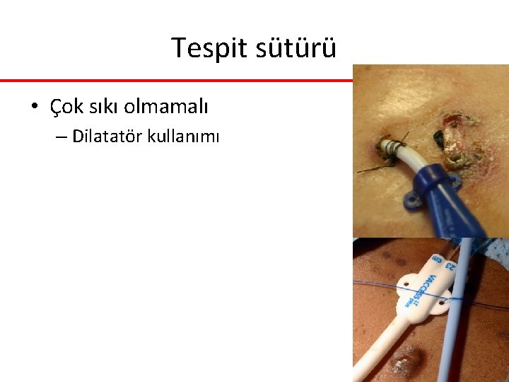 Tespit sütürü • Çok sıkı olmamalı – Dilatatör kullanımı Tespit sütürü • Çok sıkı olmamalı – Dilatatör kullanımı