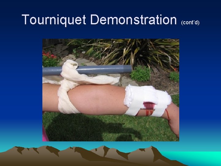 Tourniquet Demonstration (cont’d) 