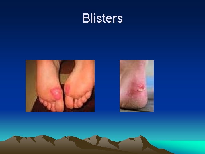 Blisters 