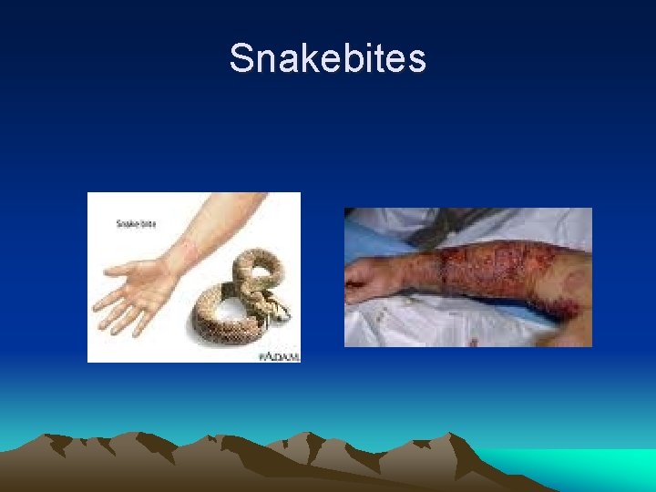 Snakebites 